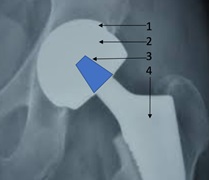 protese-lafayette-lage-raio-x-tratamento-femur-cirurgia-clinica-protese-quadril-artroscopia-artroscopia-ortopedista