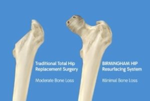 quadril-osso-protese-resurface-tratamento-cirurgia-lafayette-lage-clinica-sao-paulo-ortopedista-quadril-femur-artroscopia-ortopedista